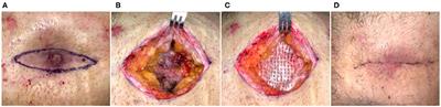 Case Report: Surgical Closure of Chronic Soft Tissue Defects Using Extracellular Matrix Graft Augmented Tissue Flaps